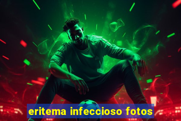 eritema infeccioso fotos